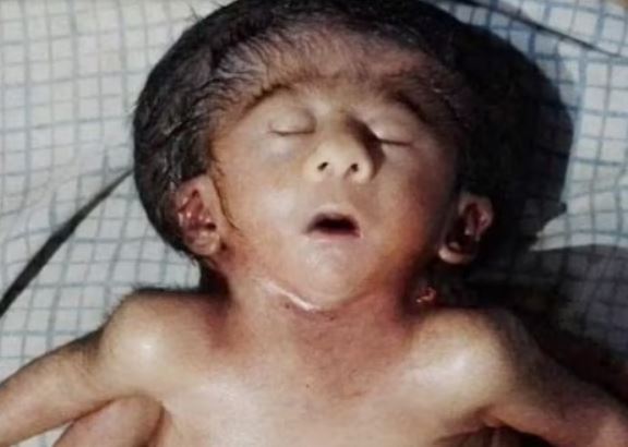 4 हाथ, 4 पैर, 2 दिल और एक सिर वाली बच्ची का जन्म, क्या है कारण