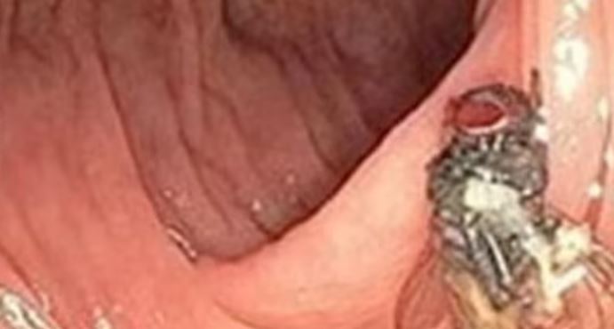63 साल के आदमी की आंत में पहुंच गई मक्खी, जांच के बाद दंग रह गए डॉक्टर